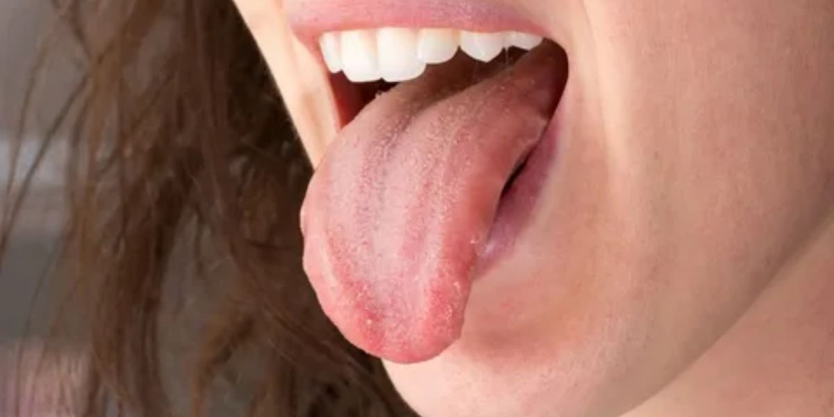 Itchy Tongue