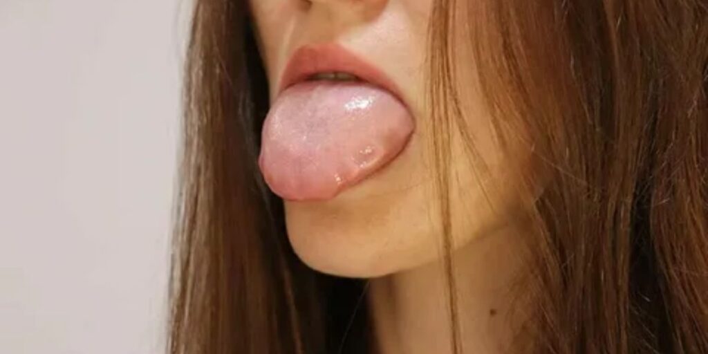  swollen tongue