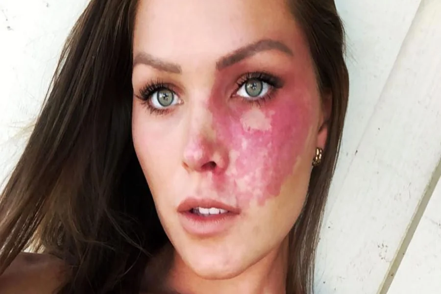 Port Wine Stain Birthmark Spiritual Meaning