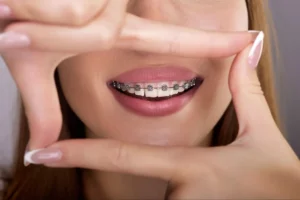 Clear Braces