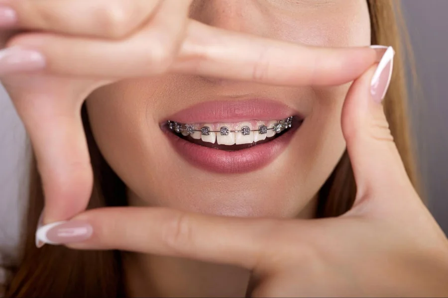 Clear Braces